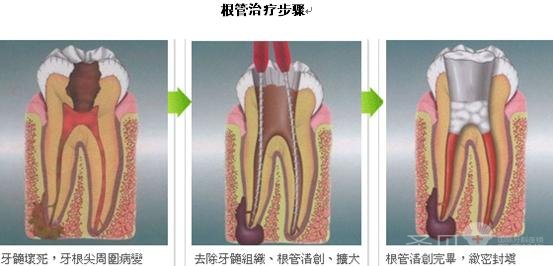 根管治疗——根除牙痛佳方法