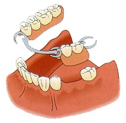 使用活动假牙需要注意哪些