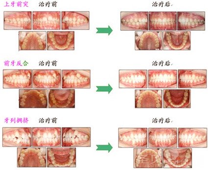 一般牙齿矫正有哪些步骤