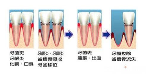牙周病的症状有哪些