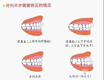 牙齿矫正佳年龄是多少？华西医生为您解答