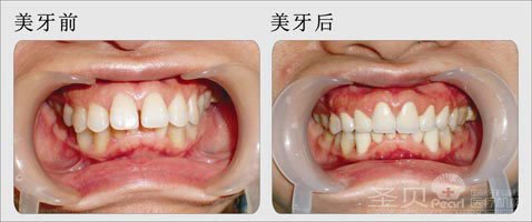 美容冠矫正龅牙要多少钱