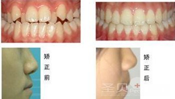 矫正牙齿会不会有年龄限制