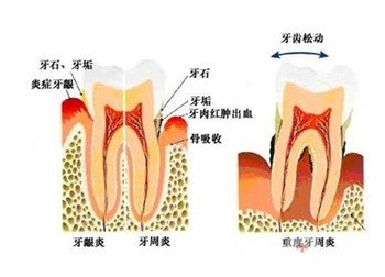 如何预防牙周病3