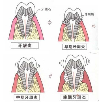 如何预防牙周病2