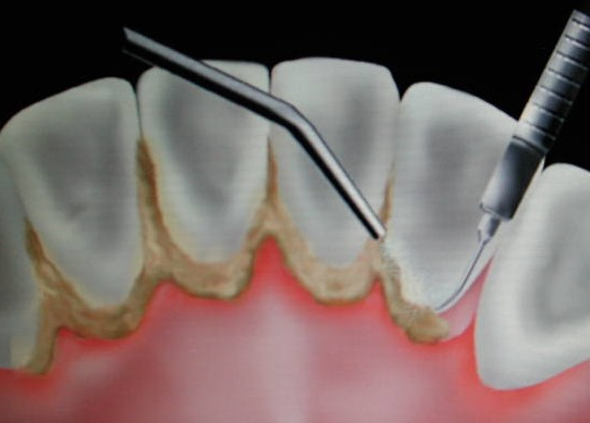 如何有效预防牙菌斑