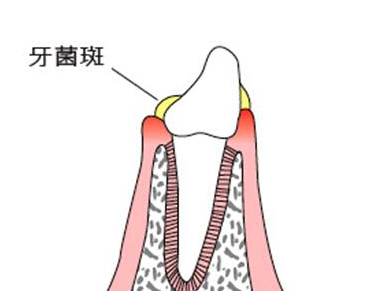 如何有效预防牙菌斑2