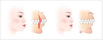 成年人龅牙怎样矫正