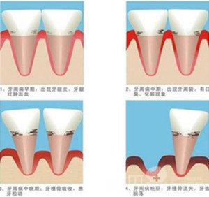 牙周炎久病不治的危害有哪些2