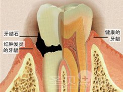 成都牙龈炎有哪些危害