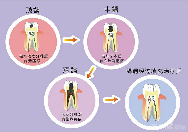 成都儿童龋齿应如何治疗3