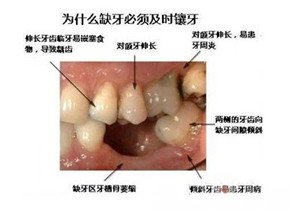 即刻种植牙轻松帮您解决缺牙烦恼3