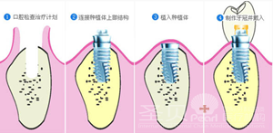 即刻种植牙轻松帮您解决缺牙烦恼4