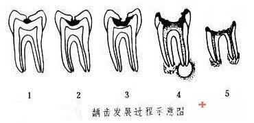 儿童乳牙患有龋齿如何治疗