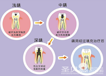 儿童乳牙患有龋齿如何治疗2