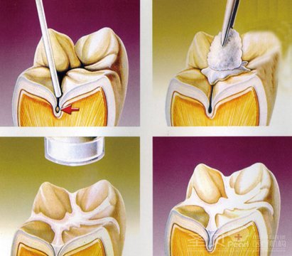 儿童乳牙患有龋齿如何治疗3