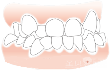 儿童牙齿拥挤怎么办1