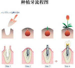 单颗牙齿缺失怎么办2