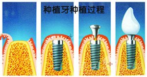 种植牙的过程是怎样的