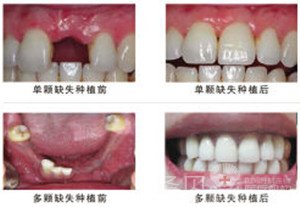 种植牙的过程是怎样的2