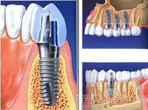 种植牙全攻略——技术篇2