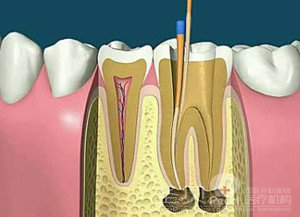 根管治疗有哪些注意事项