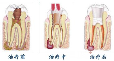 根管治疗有哪些注意事项2