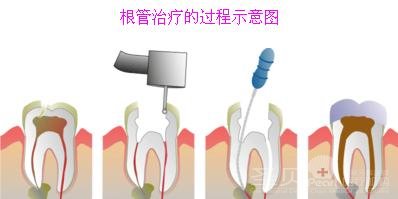 蛀牙疼痛怎么办3