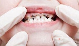 成都儿童蛀牙的检查方法