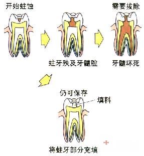 牙齿有洞怎么办2