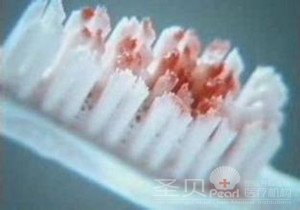 牙龈出血是什么原因引起的