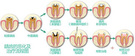 牙齿有了蛀牙怎么办2