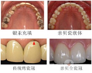 牙齿缺了一块能补吗2