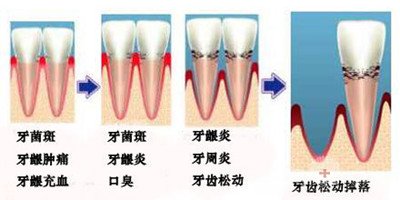 牙齿松动全攻略——技术篇2