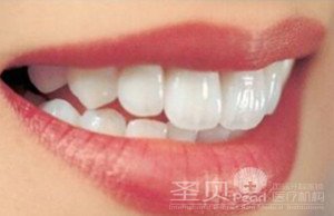 牙科揭秘：镶牙材料哪种好5