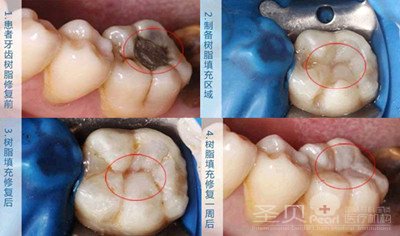 解惑：蛀牙的填充材料哪种好5