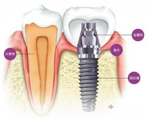 详解：种植牙的价格是多少