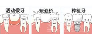 种植牙的价格贵不贵