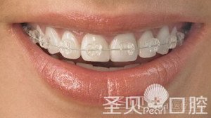 牙齿矫正五步骤 让你美丽从齿开始5