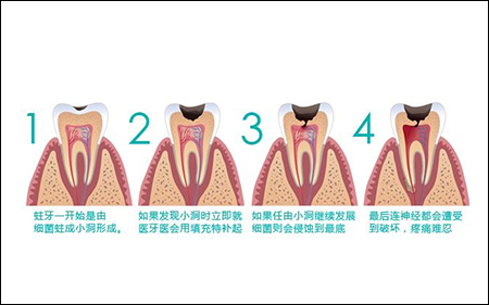 小孩牙齿怎么护理