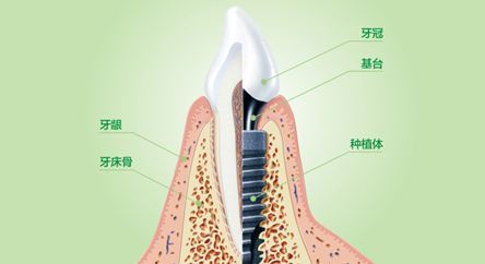 成都种植牙一只多少钱