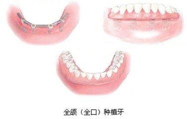 成都全口种植牙要多少钱